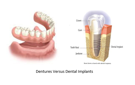 dentures versus dental implants
