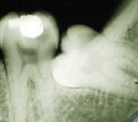 an x-ray of an impacted wisdom tooth showing a cavity on the back side of the second molar