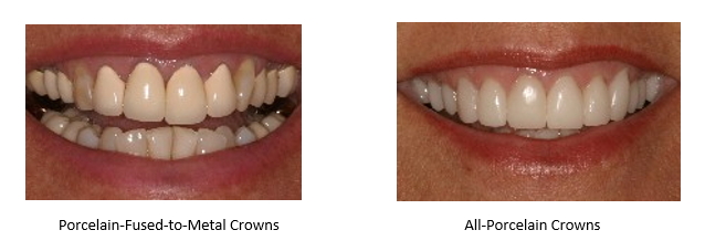 before and after all porcelain crowns